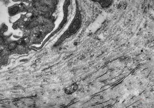 F, 48y. | lupus erythematodes … multiplicated vascular basement membrane F, 48y. | lupus erythematodes … multiplicated vascular basement membrane